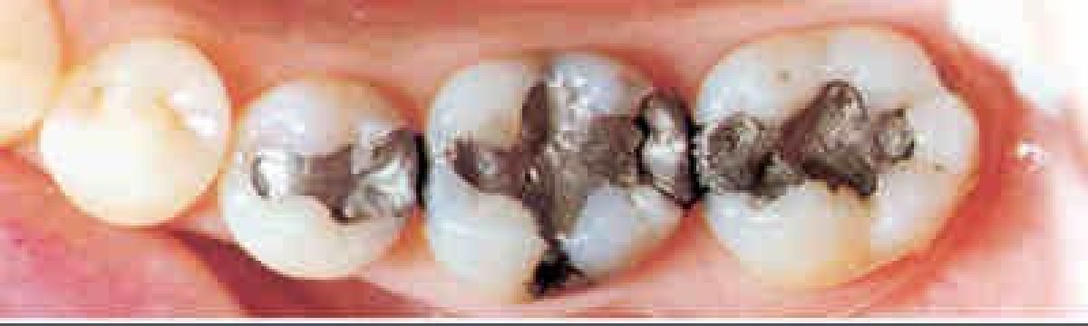 Antes de restauración dental en clínica: caries visibles y empastes metálicos resultado