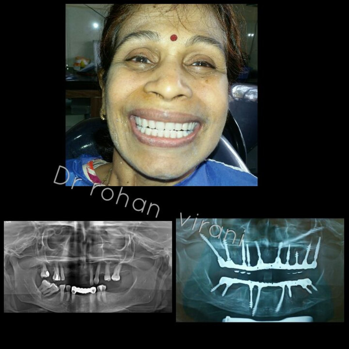 Resultados de implante dental con corona, restauración total visible en radiografías