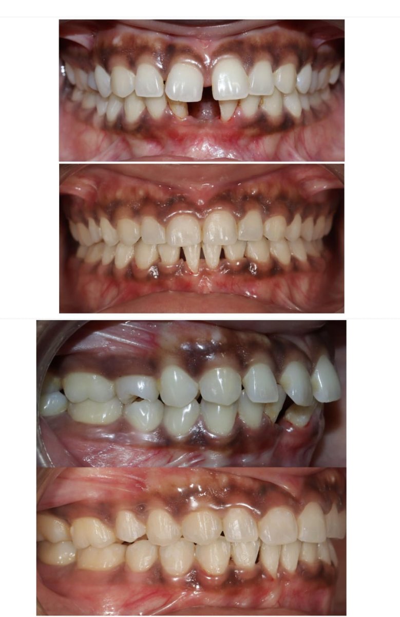نتائج قبل وبعد تجميل الابتسامة – تحسين محاذاة الأسنان والمظهر الجمالي
