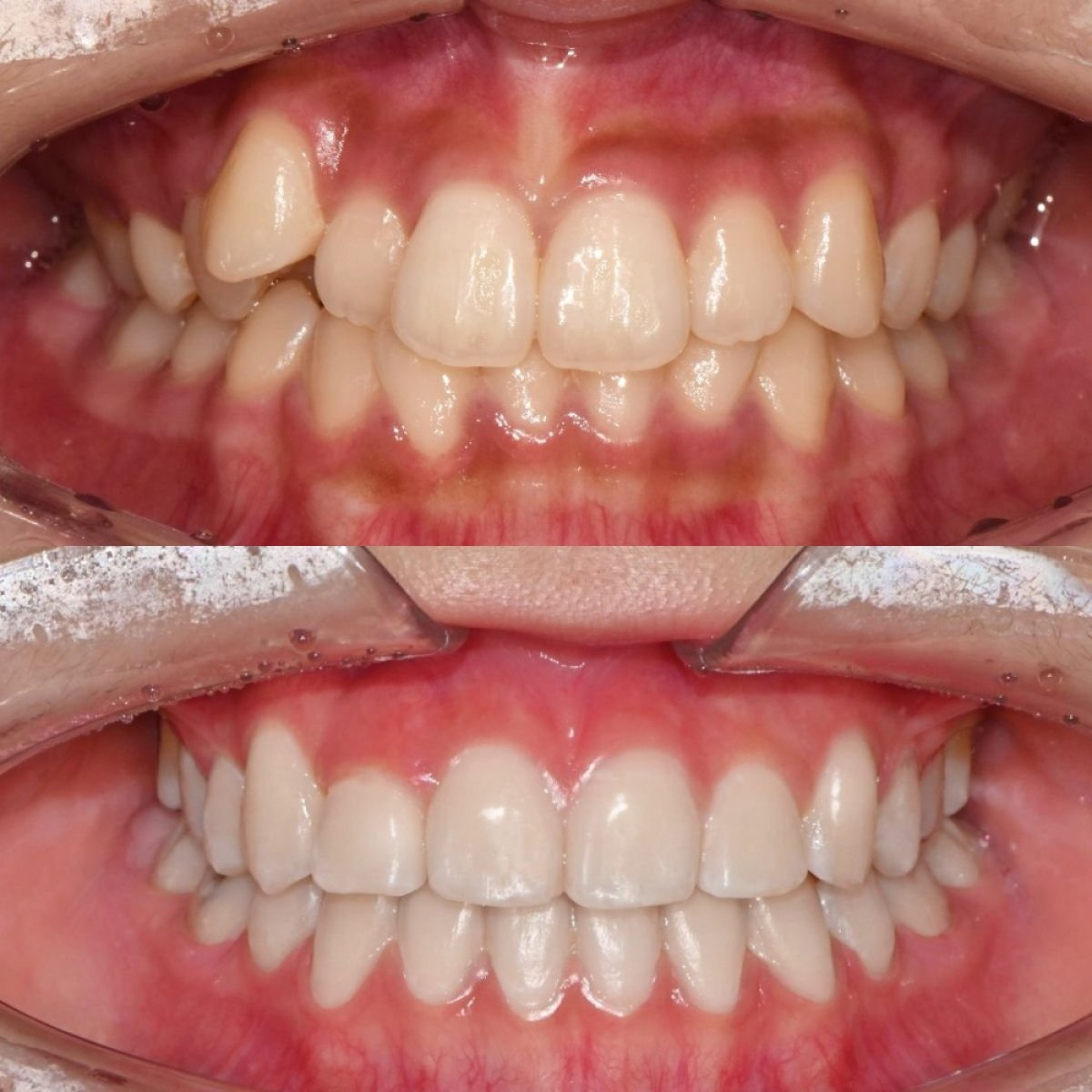نتائج قبل وبعد تقويم الأسنان في 365 Seoul OneTop Dental Clinic، تحسين ترتيب الأسنان