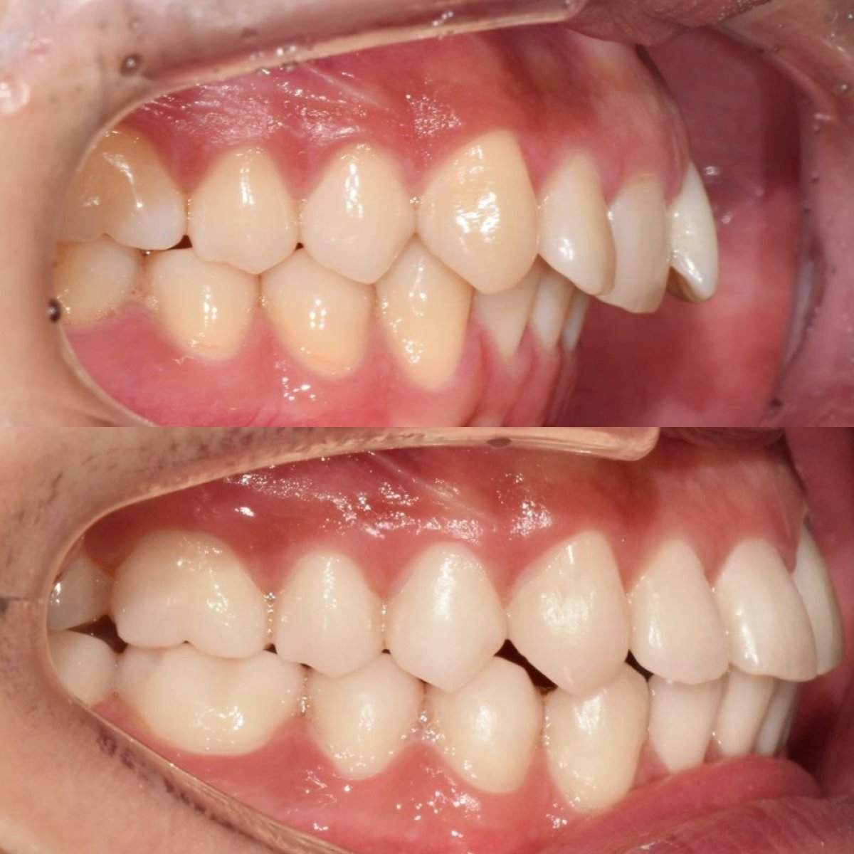Resultados antes y después de brackets en 365 Seoul OneTop Dental Clinic – alineación dental