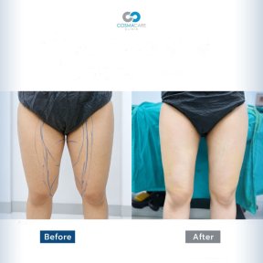 before-after photo vaser-liposuction