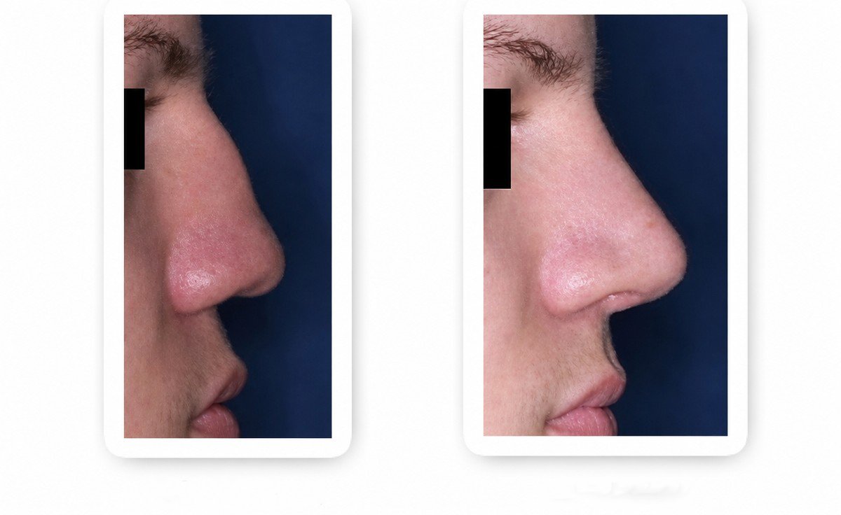 نتائج عملية تجميل الأنف قبل وبعد، إعادة تشكيل الأنف وتحسين المظهر الجانبي