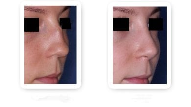 Before and after rhinoplasty results, nose reshaping with improved profile and symmetry