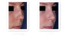 Before and after rhinoplasty results, nose reshaping with improved profile and symmetry