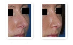 نتائج عملية تجميل الأنف قبل وبعد، إعادة تشكيل الأنف وتحسين التناسق