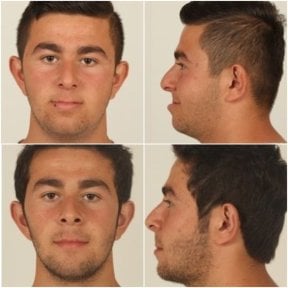 before-after photo jaw-shaping