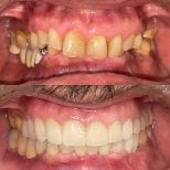 Before and after teeth cleaning (scaling) results – improved dental health and whiter smile