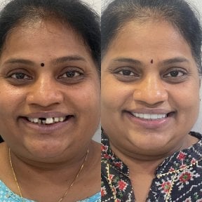 Smile makeover before and after results – dental restoration with improved teeth alignment