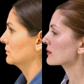before-after photo neck-lift