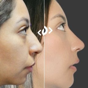 before-after photo rinoplastika-plastika-nosa