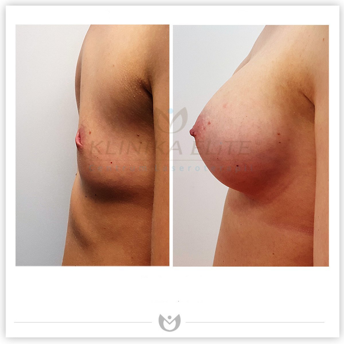 Resultados antes y después de aumento de senos en Klinika Elite Centrum Laseroterapii