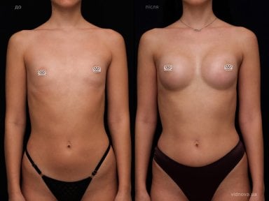 Résultats avant et après augmentation mammaire à la Vidnova Clinic, forme améliorée