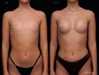 Résultats avant et après augmentation mammaire à la Vidnova Clinic, forme améliorée