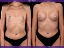 Before and after breast augmentation results at Vidnova Clinic – enhanced breast shape