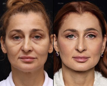 before-after photo breast-augmentation