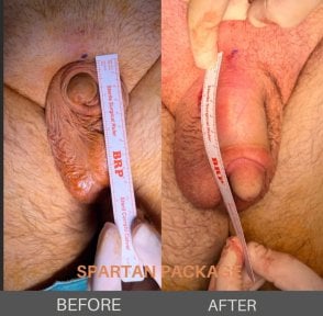 before-after photo penis-enlargement