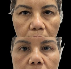 نتائج شد الحاجب قبل وبعد، رفع الحاجبين ونعومة الجبهة بشكل واضح