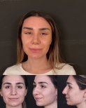 نتائج عملية تجميل الأنف قبل وبعد، إعادة تشكيل الأنف لتحسين تناسق الوجه