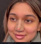 نتيجة عملية تجميل الأنف مع أنف مغطى بعد الجراحة، تغيير شكل الأنف واضح