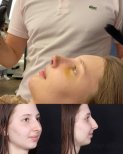 نتائج عملية تجميل الأنف قبل وبعد، إعادة تشكيل الأنف لتحسين المظهر والتناغم