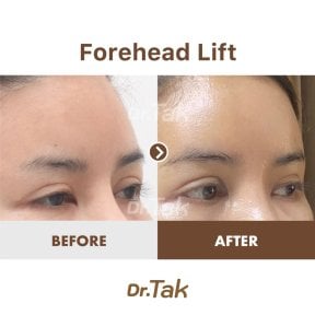 before-after photo fox-eye-surgery