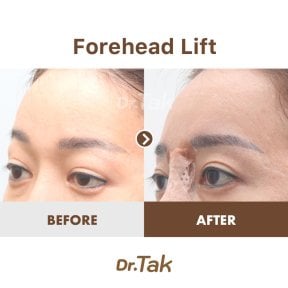 before-after photo fox-eye-surgery