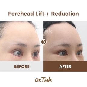 before-after photo fox-eye-surgery