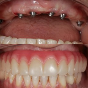 Before and after All-on-6 dental implants result at Clínica Zago, full upper arch restoration