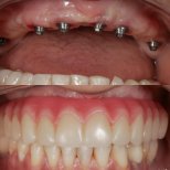 Before and after All-on-6 dental implants result at Clínica Zago, full upper arch restoration