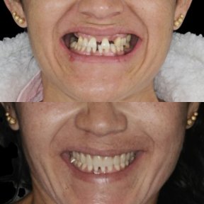 Before and after All-on-4 dental implants result at Clínica Zago, improved smile transformation