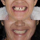 Before and after All-on-4 dental implants result at Clínica Zago, improved smile transformation