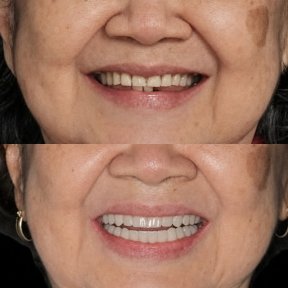 Before and after dental crown installation at Clínica Zago, improved smile aesthetics result