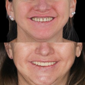 Before and after dental crown installation at Clínica Zago, improved smile aesthetics result