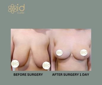 Результаты до и после уменьшения груди в ID Clinic Bangkok, видимое улучшение формы