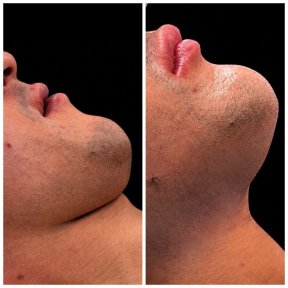 Vorher-nachher-Ergebnis der Genioplastik bei Klinika Promedion, verbesserte Kinnkontur