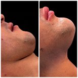 Vorher-nachher-Ergebnis der Genioplastik bei Klinika Promedion, verbesserte Kinnkontur