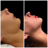Vorher-nachher-Ergebnis der Sliding-Genioplastik bei Klinika Promedion, Kinnkontur verbessert
