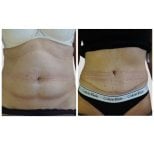 Résultats avant et après abdominoplastie à Klinika Promedion, contour abdominal amélioré