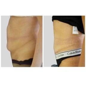Résultats avant/après abdominoplastie à Klinika Promedion, ventre plus plat