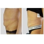 Résultats avant/après abdominoplastie à Klinika Promedion, ventre plus plat