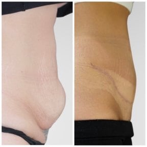Résultats avant/après abdominoplastie à Klinika Promedion – ventre plus plat