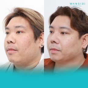 Результаты липосакции подбородка до и после в Wansiri Hospital, улучшенный контур