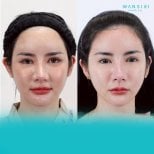 Результаты липосакции подбородка до и после в Wansiri Hospital, улучшенный контур челюсти