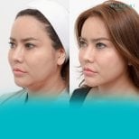 Результаты липосакции подбородка до и после в Wansiri Hospital, улучшенный контур челюсти