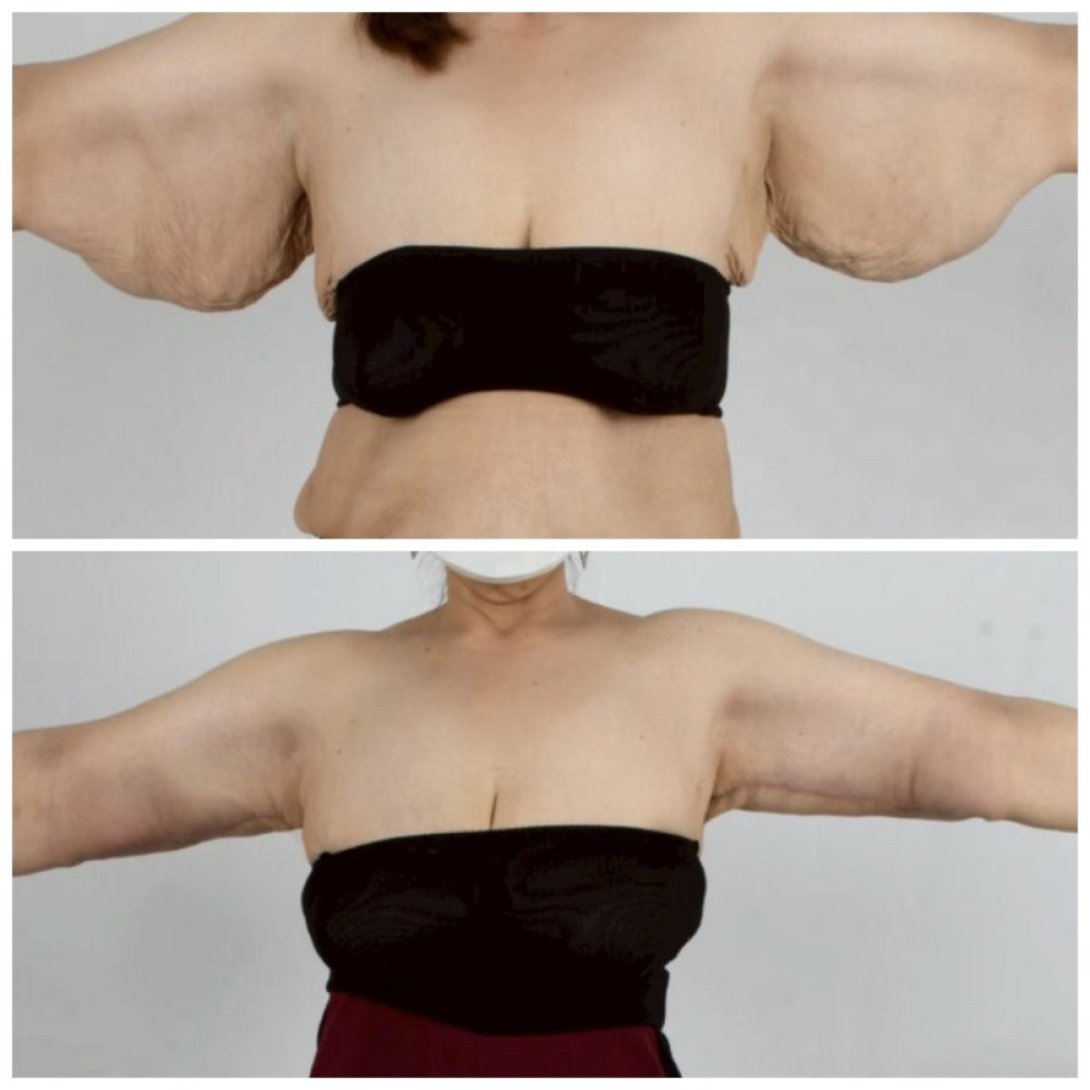 Resultados de lifting de brazos (braquioplastia) antes y después en Somchai Clinic