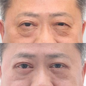 Before and after blepharoplasty results at Dr. Tak Plastic Surgery, eyelid correction improvement