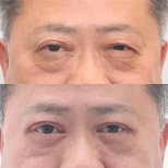 Before and after blepharoplasty results at Dr. Tak Plastic Surgery, eyelid correction improvement