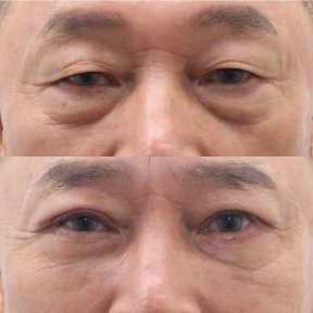 Before and after blepharoplasty results at Dr. Tak Plastic Surgery, eyelid correction improvement