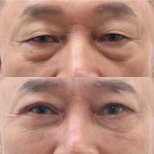 Before and after blepharoplasty results at Dr. Tak Plastic Surgery, eyelid correction improvement